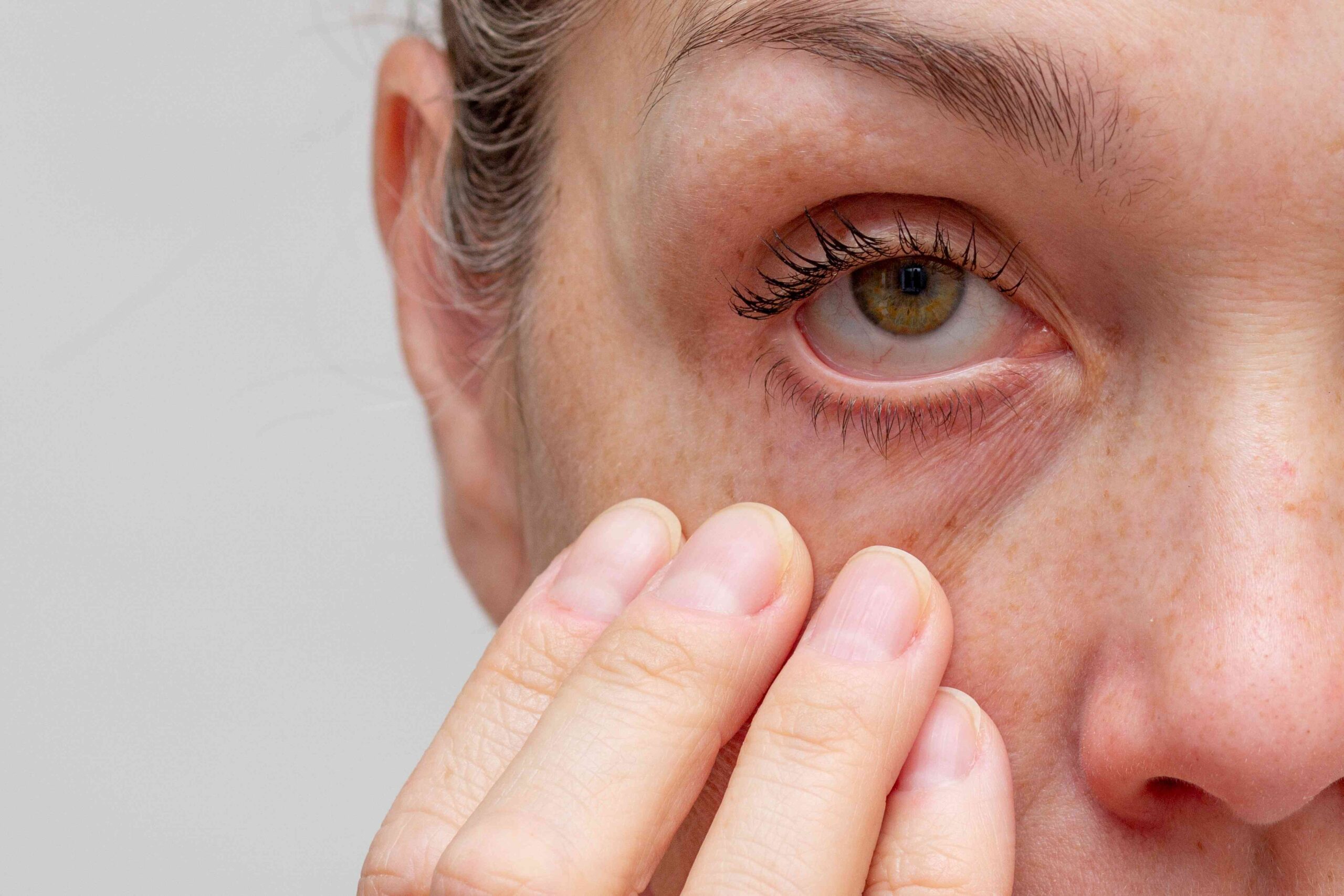 8 Causes of Crusty Eyes and How To Treat Them