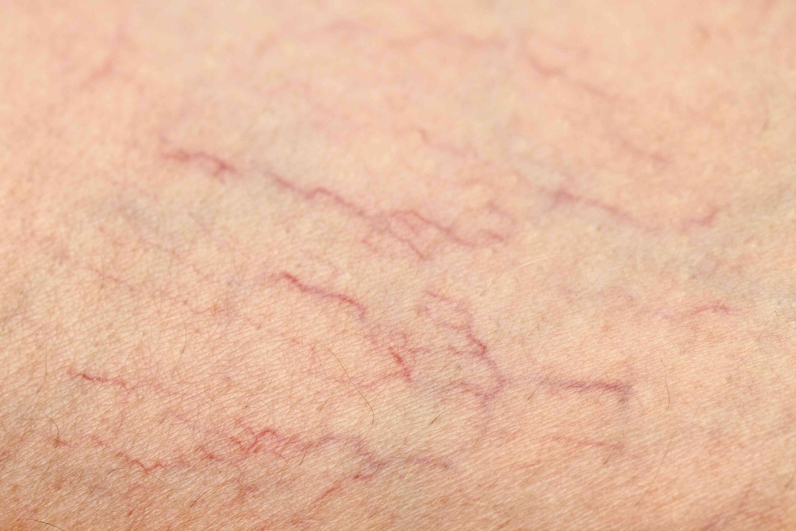 How To Prevent Spider Veins (Telangiectasias)