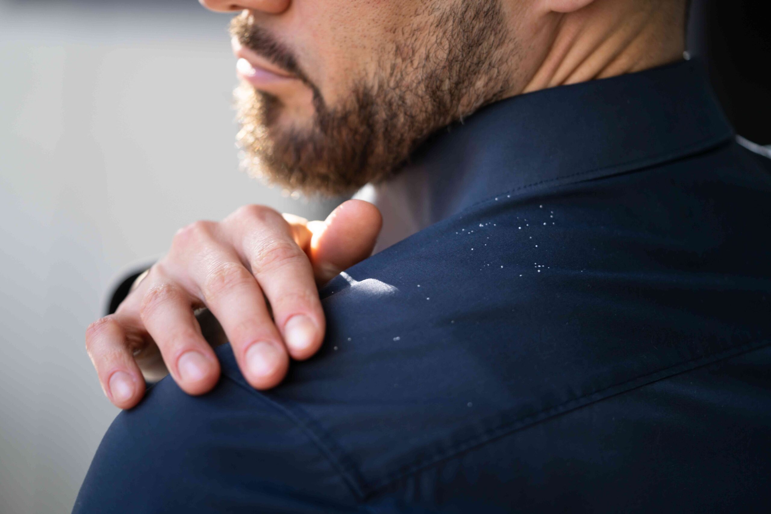 3 Types of Dandruff: Causes, Treatment, and Prevention