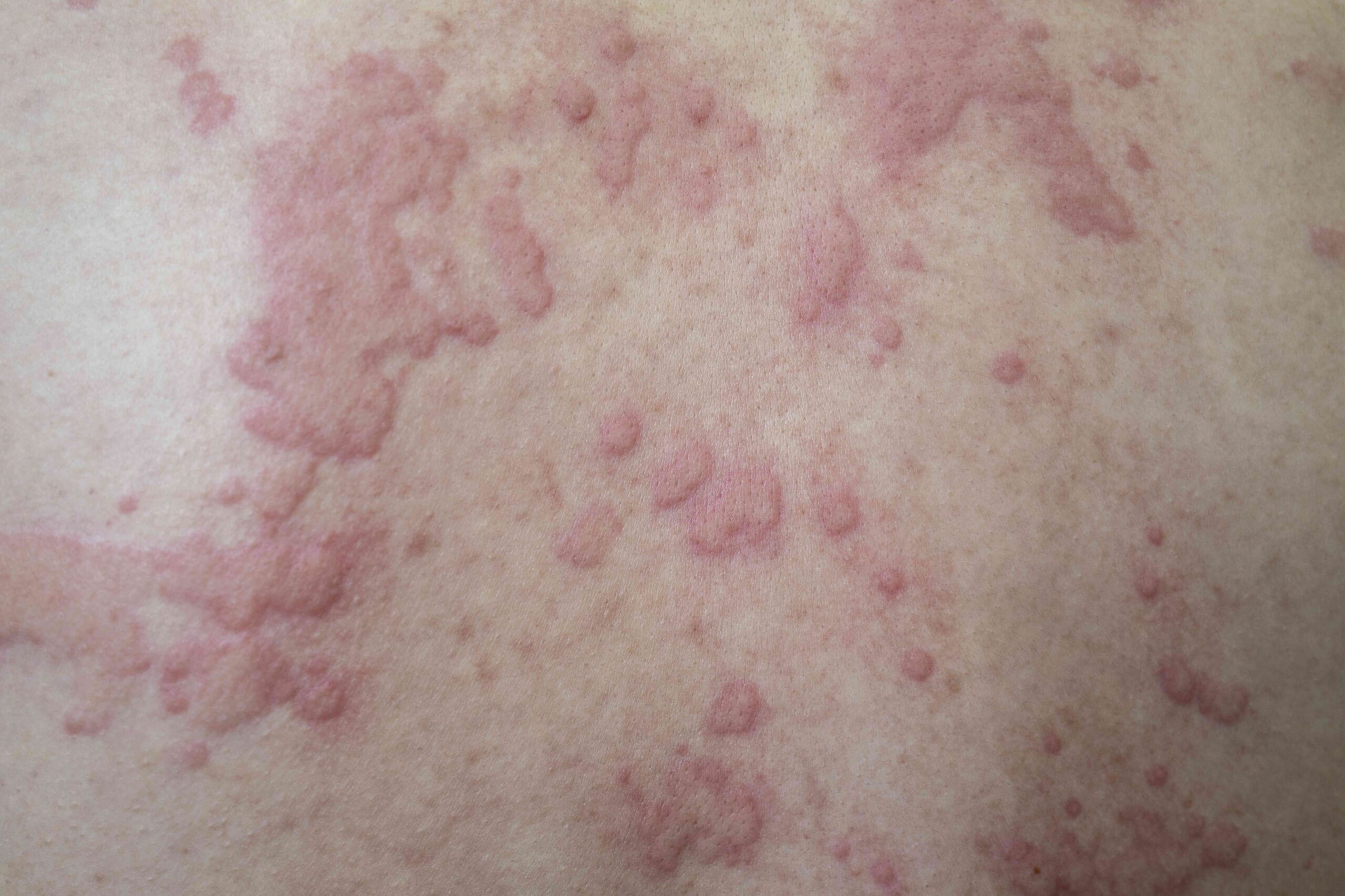 Hives vs. Eczema: What’s the Difference?