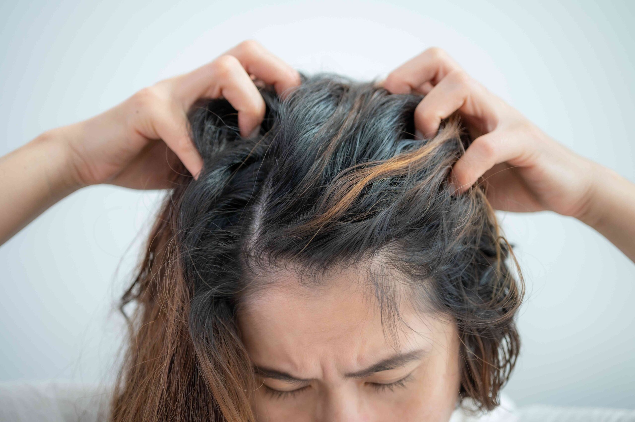 Lice vs. Dandruff: Differences and Similarities